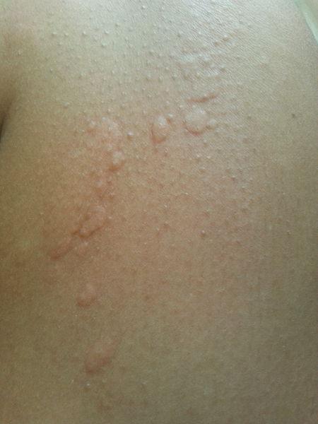Koude urticaria Koude urticaria | © Wikipedia